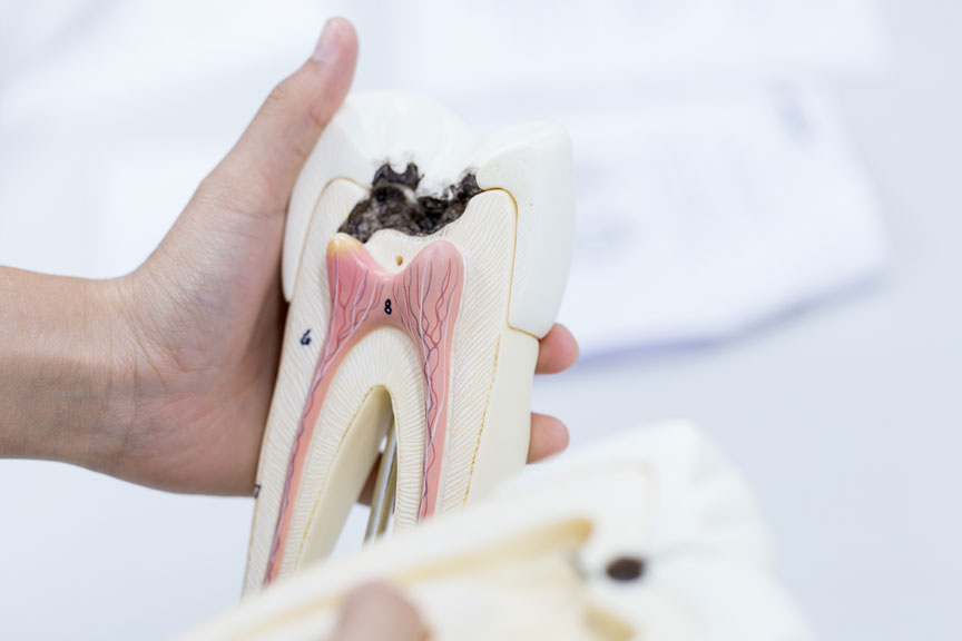 Identifying a Cavity: Important Signs to Know